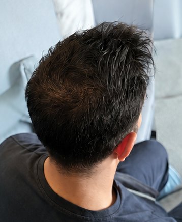Scalp at follow-up: fuller coverage at the crown