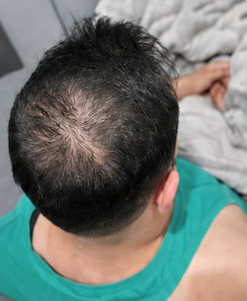Scalp before treatment: thinning at the crown